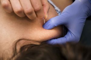 Dry Needling, aiguille sèche